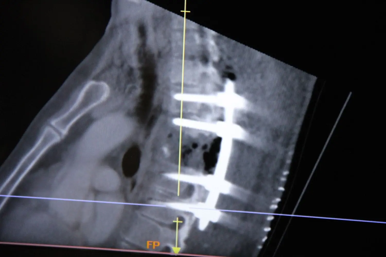 Mit acht Schrauben ist die Wirbelsäule des Patienten stabilisiert worden.