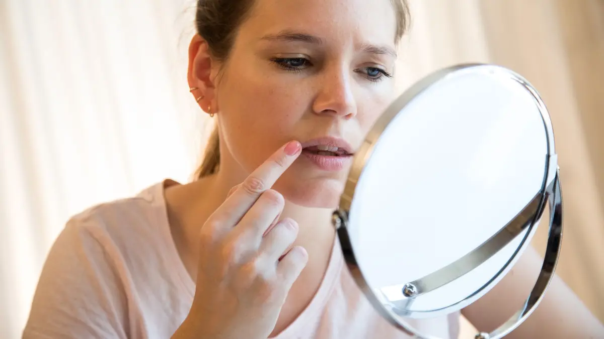Lippenherpes: ILLUSTRATION - Bildet sich da etwa Herpes? Rezeptfreie Arzneimittel sowie Medizinprodukte versprechen eine schnellere Heilung. Die Stiftung Warentest ist nicht überzeugt. (zu dpa: «Gele, Cremes, Patches: Wie gut helfen sie bei Herpes?») Foto: Christin Klose/dpa-mag - Honorarfrei nur für Bezieher des Dienstes dpa-Magazin +++ dpa-Magazin +++