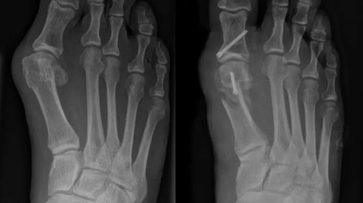 Röntgenbild vor (links) und nach (rechts) einer Hallux valgus-Operation.