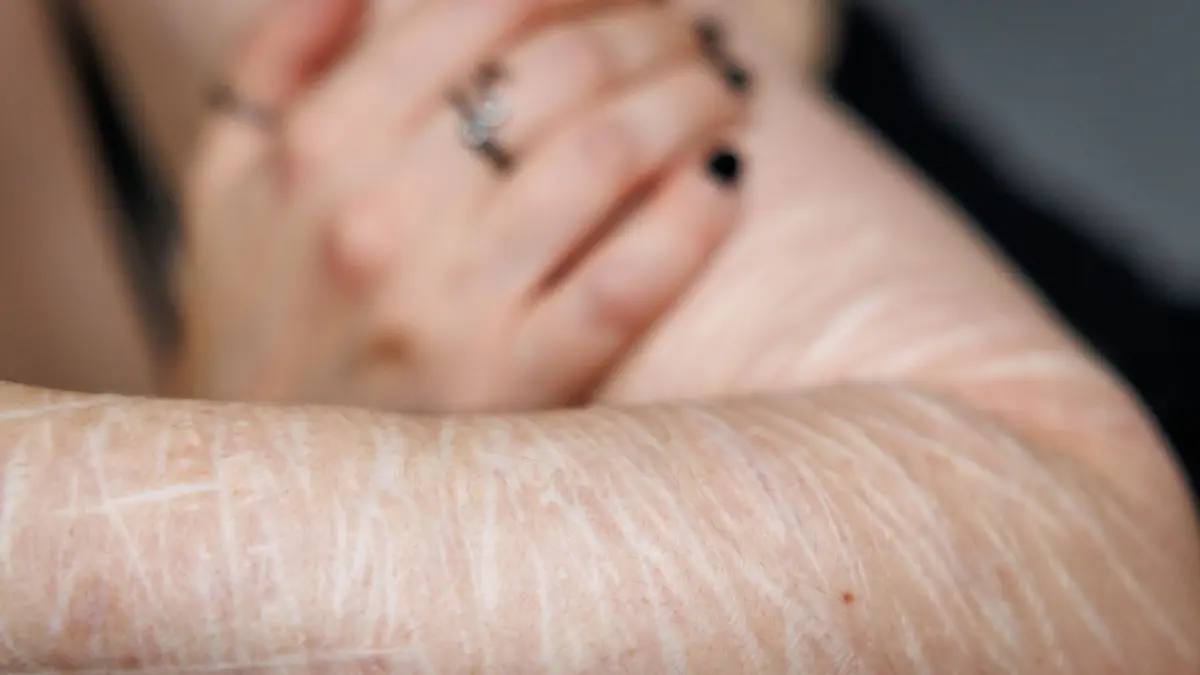 Selbstverletzung der Haut: ARCHIV - 10.10.2024, Bayern, Nürnberg: Eine Betroffene von selbst verletzendem Verhalten zeigt Narben auf ihrem Arm. Sie alle zeugen von tiefen Schnitten mit Rasierklingen, die sich die 31-Jährige selbst zugefügt hat. Die junge Frau aus Nürnberg hat eine Borderline Persönlichkeitsstörung - eine psychische Erkrankung, bei der Betroffene unter starken Gefühls- und Stimmungsschwankungen leiden. Viele Betroffene verletzen sich selbst, um die innere Anspannung zu verringern. (zu dpa: «Selbstverletzungen - welche Rolle spielt das Internet?») Foto: Daniel Karmann/dpa +++ dpa-Bildfunk +++