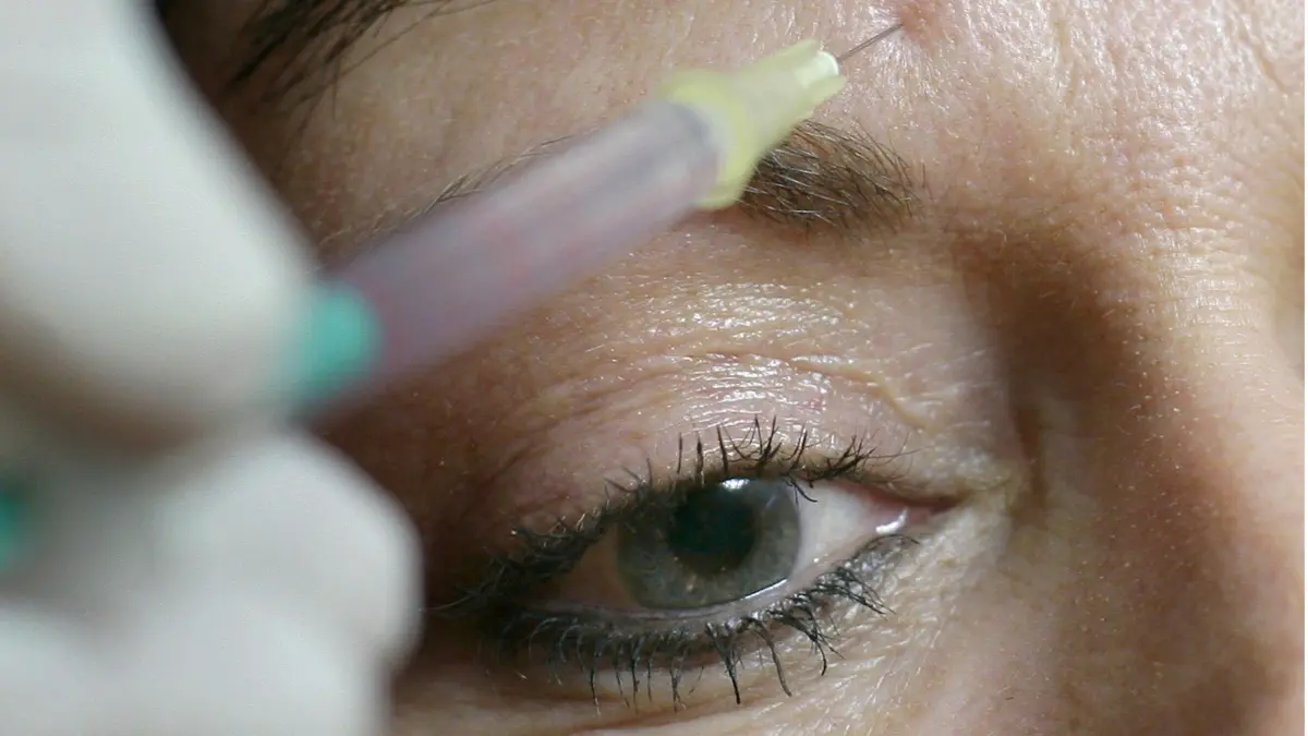 ARCHIV - ILLUSTRATION - Ein Chirurg drückt am 16.01.2007 in Berlin einer jungen Frau eine Spritze mit «Botox» an die Stirn. Forscher aus Hannover und Basel fanden jetzt Hinweise darauf, dass Botox-Spritzen nicht nur Falten glätten, sondern auch Depressionen lindern können. Foto: Peer Grimm (zu dpa «Studie: Nervengift Botox kann vielleicht Depressionen lindern» vom 27.02.2012) +++(c) dpa - Bildfunk+++