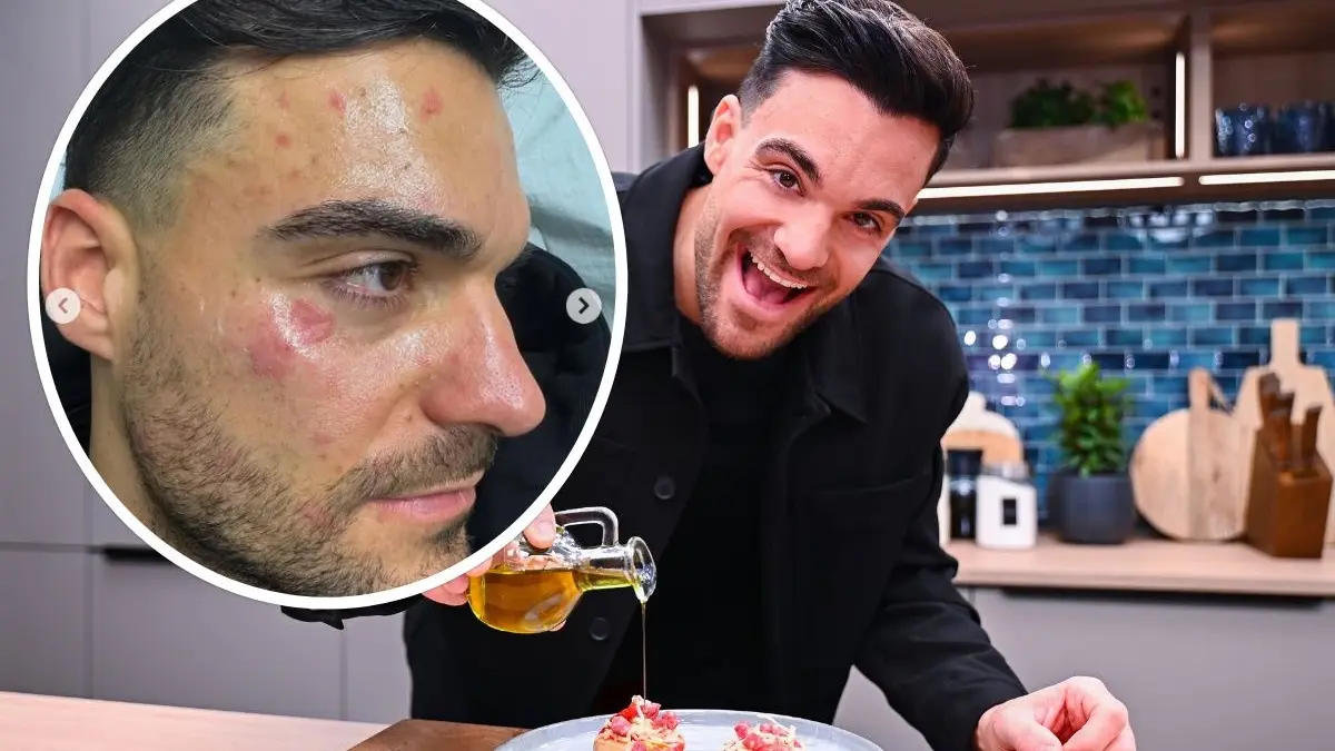 Food-Influencer und Frohnatur Stefano Zarrella hatte einen Unfall beim Kochen. Heißes Fett spritzte ihm ins Gesicht.