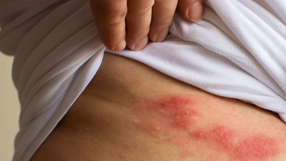 Bildnr. 504171146, Beachten: nur redaktionelle Nutzung!Gürtelrose (Herpes zoster) – Bläschenbildung auf der Haut, Gesundheit, Download am 15.12.25 für SWUM print und online