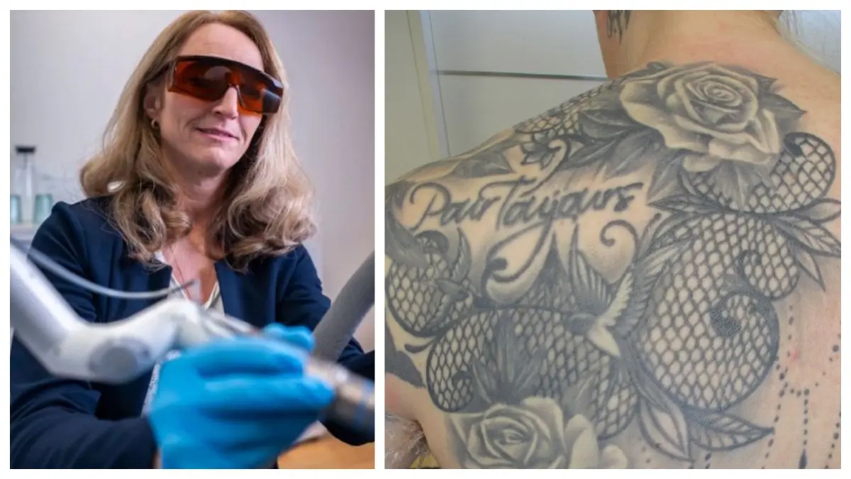 Tattooentfernung in Ulm