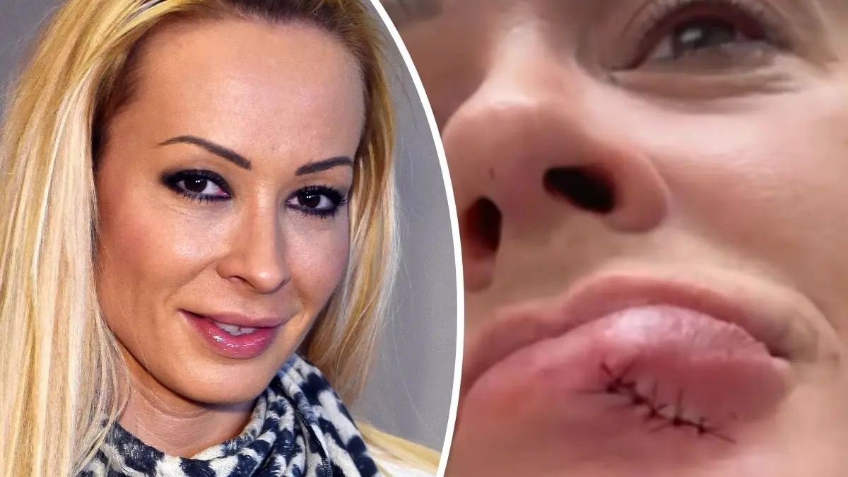 Cora Schumacher musste an der Lippe genäht werden.